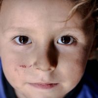 Young boy with cut on face